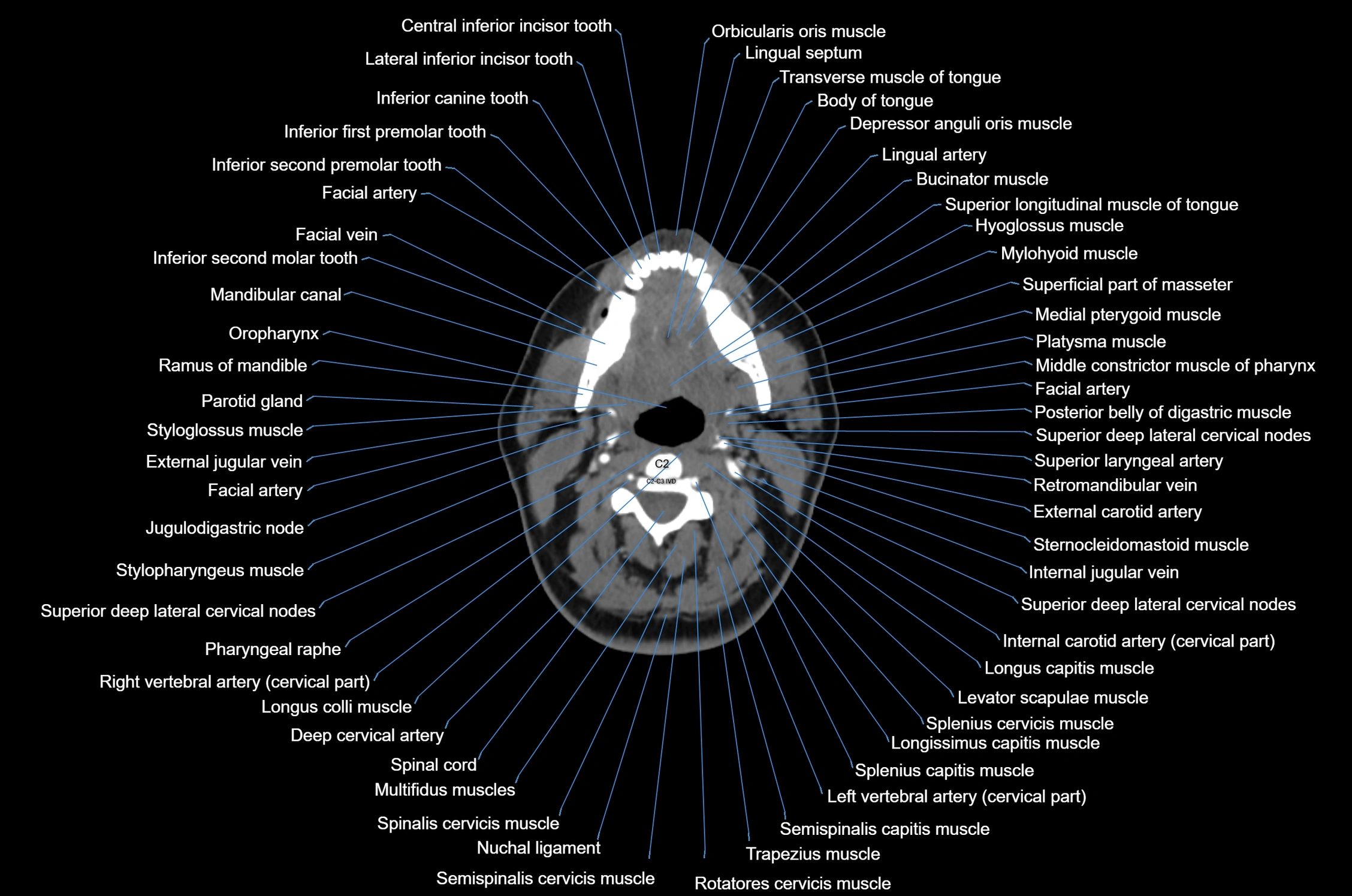 CT Neck axial cross sectional anatomy radiology image-img-00001-00031.webp